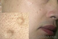 Athrophic Scar