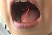 Cara Mengobati Bibir Bengkak