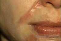 Hyperthrophic Scar