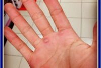 Cara Mengobati Kulit Kapalan Pada Tangan dan Kaki