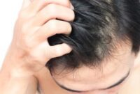 5 Tips Menghilangkan Gatal di Kulit Kepala